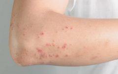 Remédio Caseiro de Óleo de Camomila Ajuda Tratar Dermatite – Receita e Como Aplicar