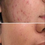 acne-marcas