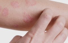 Remédio Caseiro de Urtiga Com Cavalinha Para Dermatite – Receita e Como Aplicar