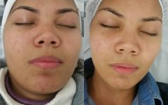 Peeling do Mar Morto Elimina Melasma e Manchas – Como Funciona, Onde Fazer e Benefícios