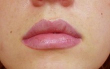 Queiloplastia Para os Lábios – Como Funciona e Benefícios