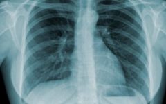 Remédio Caseiro de Salgueiro Alivia Sintomas Tuberculose – Receita, Como Consumir e Benefícios
