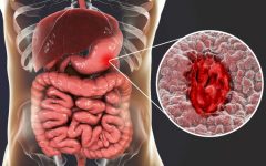 Purê de Repolho Alivia Sintomas Úlcera no Estômago – Receita, Como Consumir e Benefícios