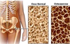 Remédio Caseiro de Gergelim Alivia Sintomas Osteoporose – Receita, Como Consumir e Benefícios