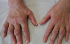Remédio Caseiro de Salgueiro Ajuda Tratar Artrite Reumatoide – Receita, Como Consumir e Benefícios