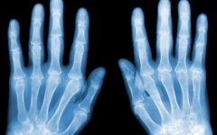 Remédio Caseiro de Abacate Ajuda Tratar Artrose – Receita e Como Aplicar