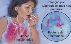 Remédio Caseiro de Equinácea Para Aliviar Sintomas Tuberculose – Receita, Como Consumir e Benefícios