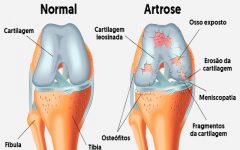 Remédio Caseiro de Salgueiro Trata Artrose – Receita, Como Consumir e Benefícios