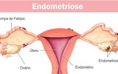 Suco de Laranja Com Morango Alivia Sintomas Endometriose – Receita, Como Consumir e Benefícios