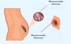 Remédio Caseiro de Camomila Trata Hemorroida – Receita e Como Aplicar