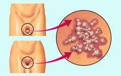 Remédio Caseiro de Óleo de Niaouli Trata Herpes Genital – Receita e Como Aplicar