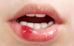 Remédio Caseiro de Dente de Leão Trata Candidíase – Receita, Como Consumir e Benefícios