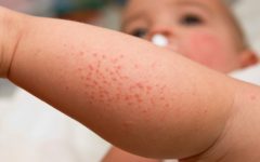 Remédio Caseiro Para Alergia na Pele – Receita e Como Consumir