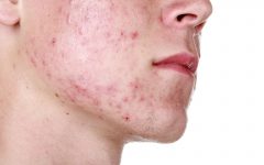 Sabonete Caseiro Para Acne – Receita e Benefícios