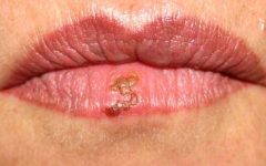 Xarope de Bardana Trata Herpes – Receita, Como Consumir e Benefícios